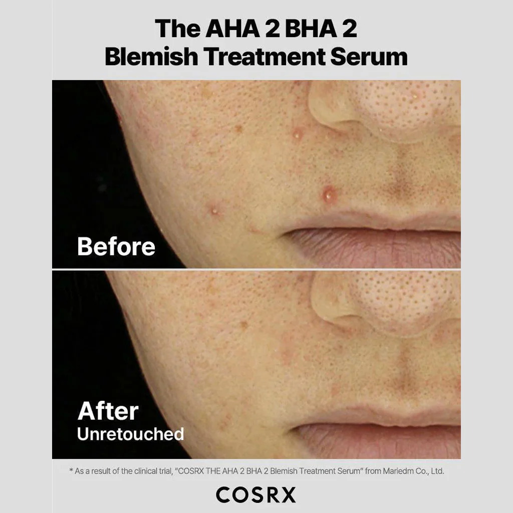 The AHA 2 BHA 2 Blemish Treatment Serum - Image 4