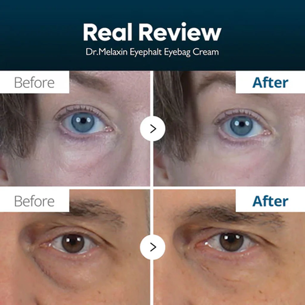 Eyephalt Eyecream for Eyebags - Image 3
