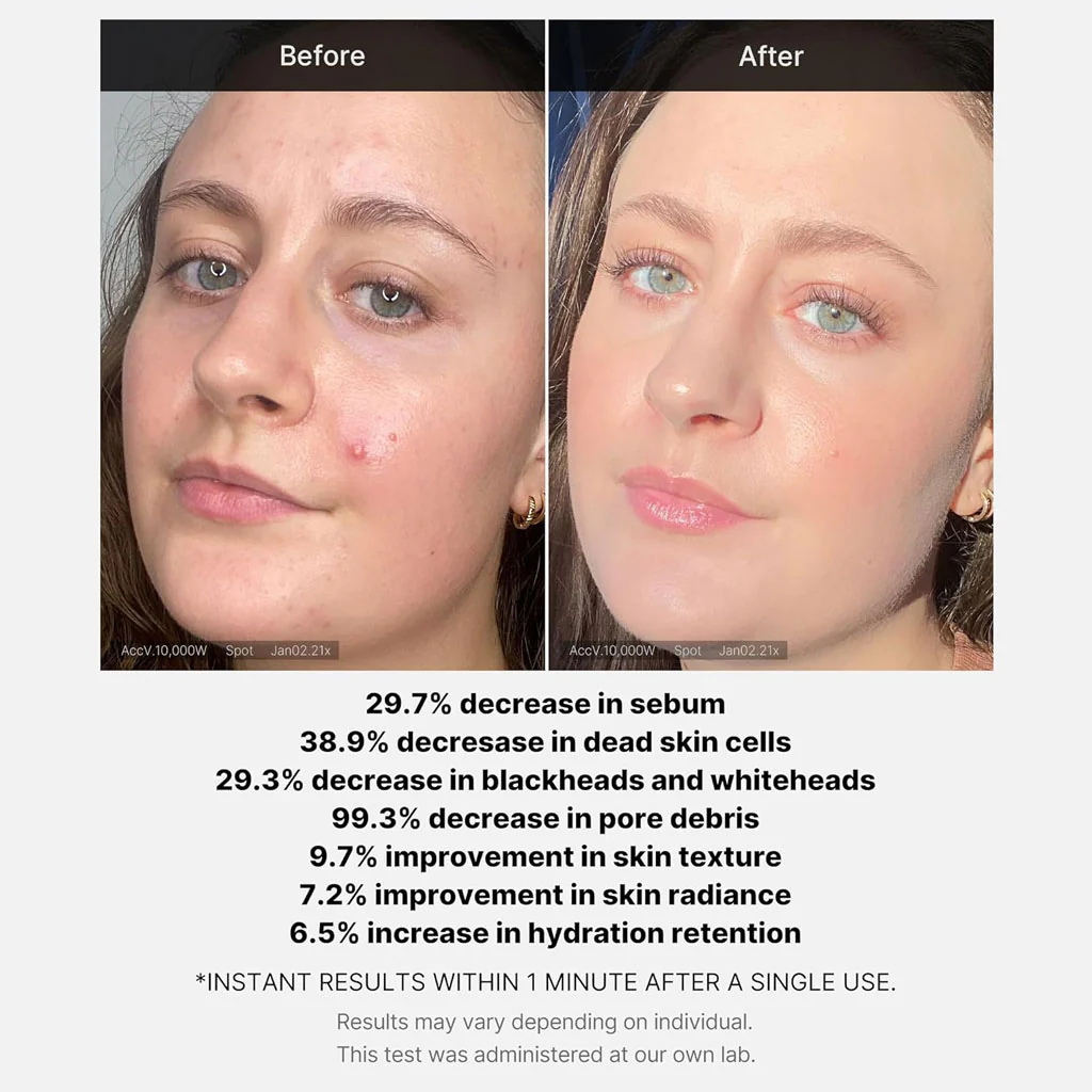 Red Acne Succinic Acid Peel (40g) - Image 3