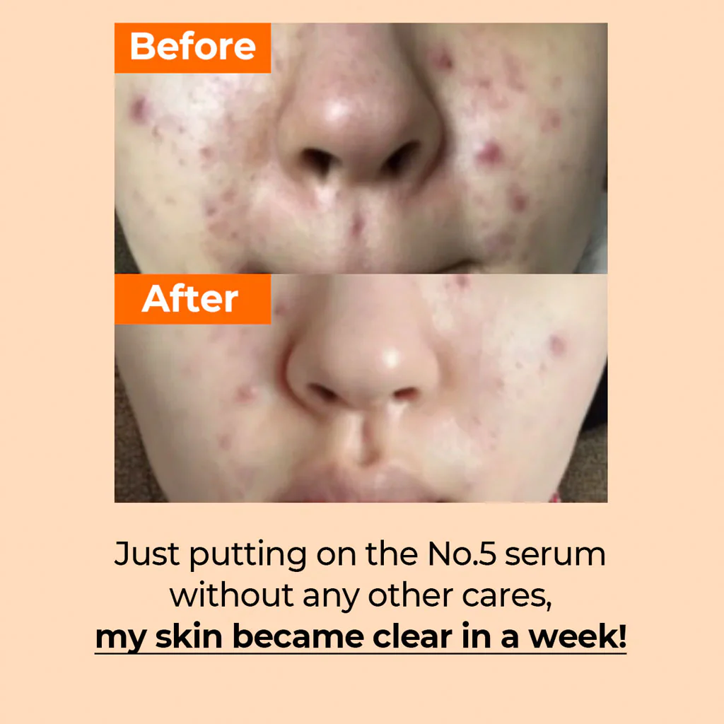 No.5 Goodbye Blemish Serum (50ml) - Image 3