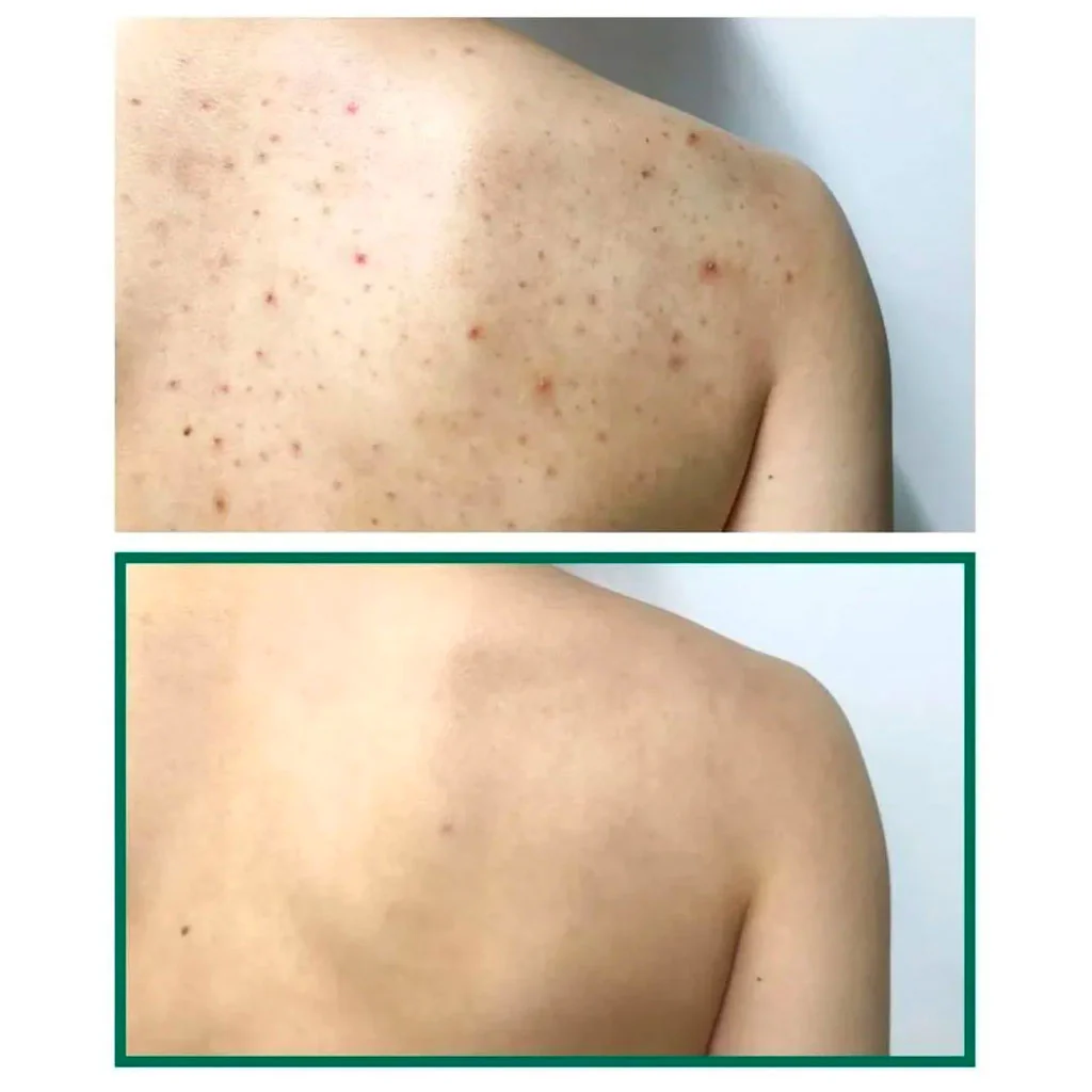 AHA BHA PHA 30 Days Miracle Acne Clear Body Cleanser (400ml) - Image 2