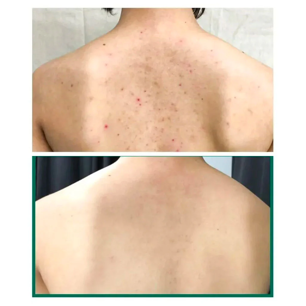 AHA BHA PHA 30 Days Miracle Acne Clear Body Cleanser (400ml) - Image 3