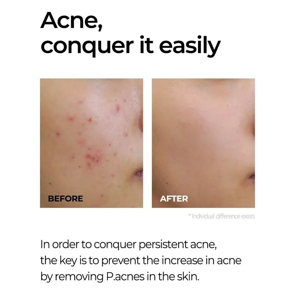 Miracle AC Clear Spot Treatment - Image 2