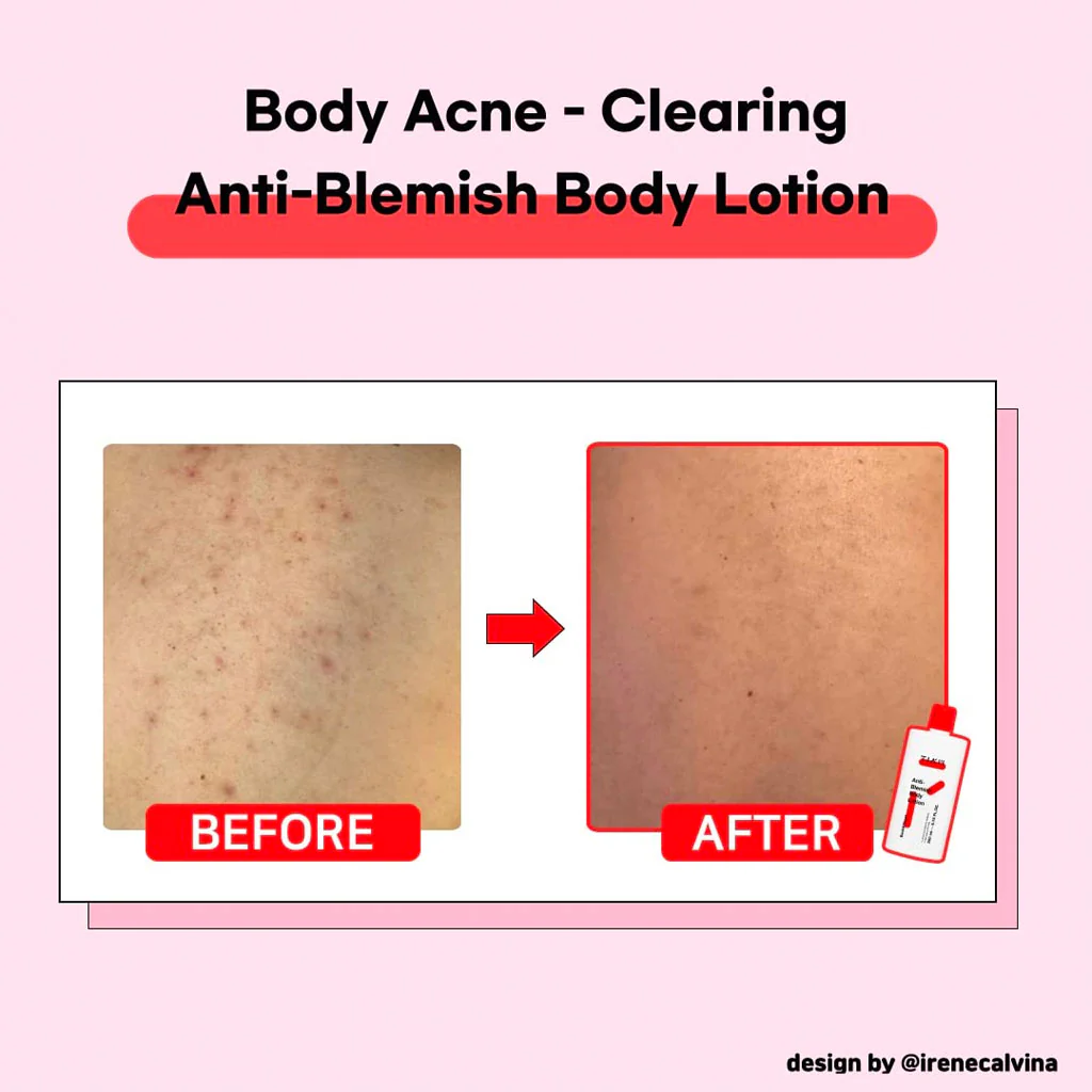 Anti-Blemish Body Lotion (Back & Chest) - Image 2